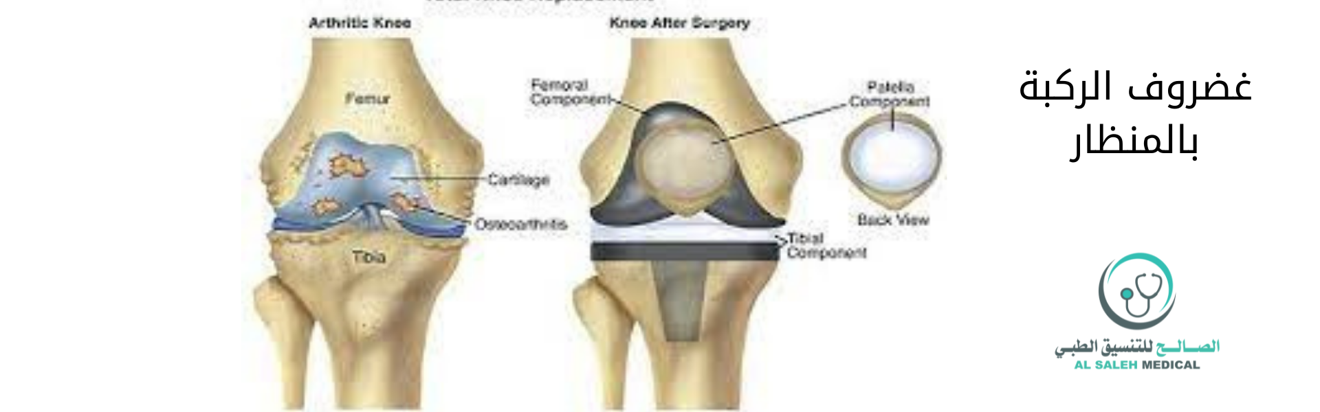 تكلفة عملية منظار غضروف الركبة في الهند | اسعار مناسبة جدا